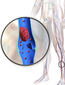 sintomas de trombose venosa profunda