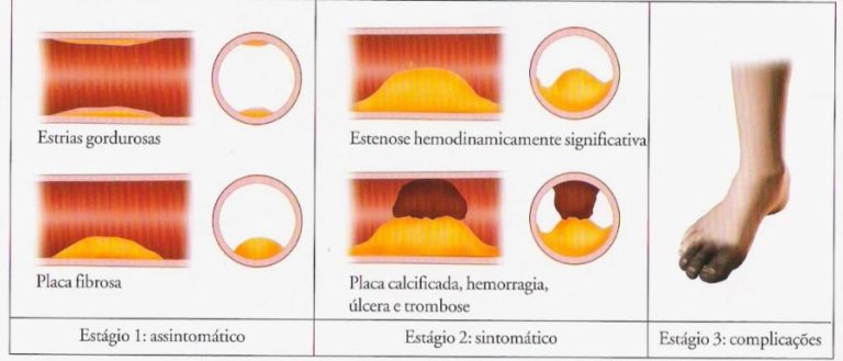 Doenças Vasculares Periféricas Tipos Causas Sintomas E Tratamentos 