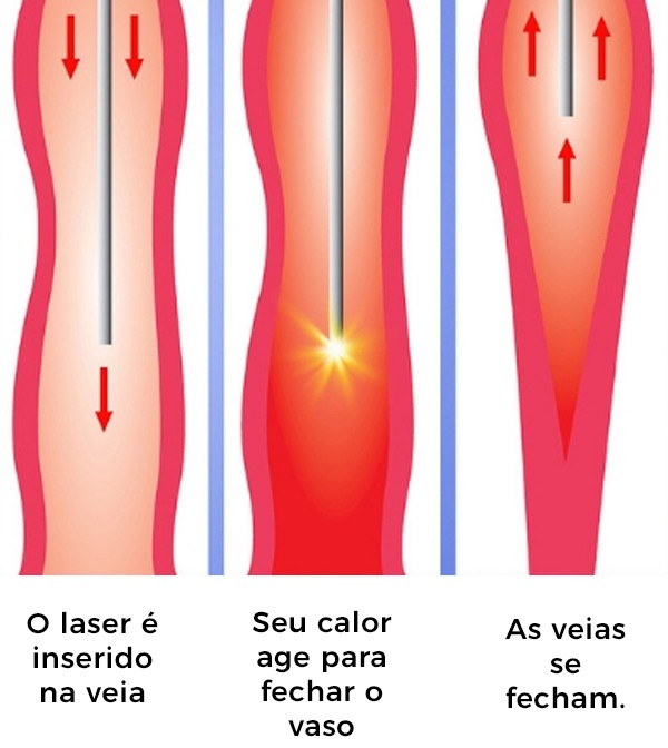 Laser endovenoso tratando varizes