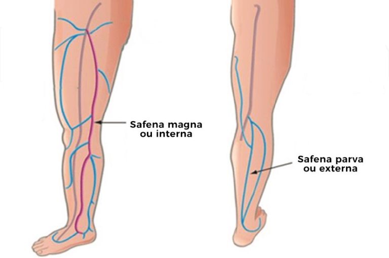 Tratamento De Veia Safena Com Laser