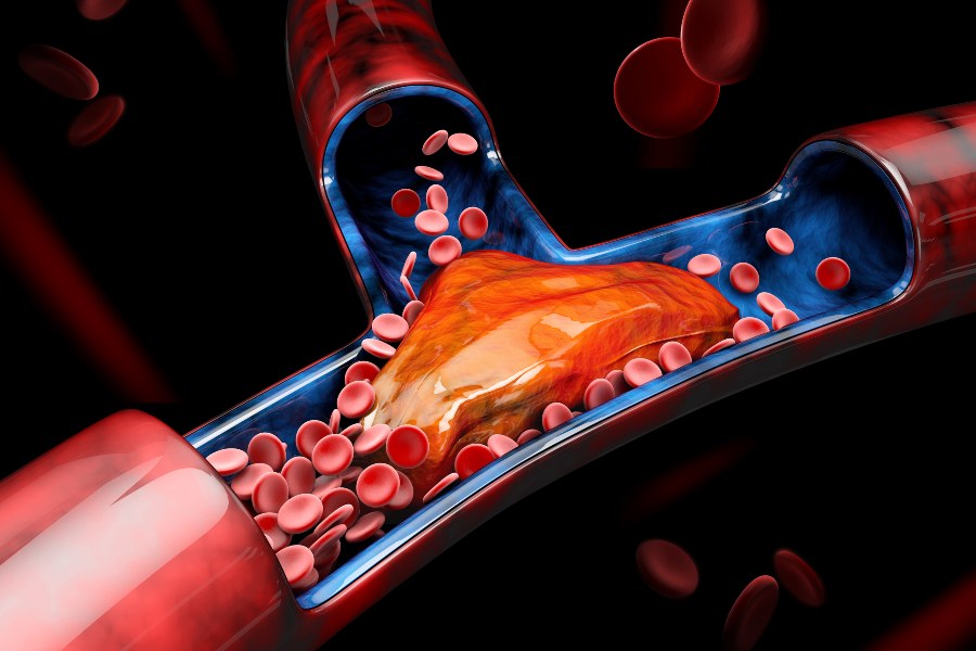 O que é trombofilia?