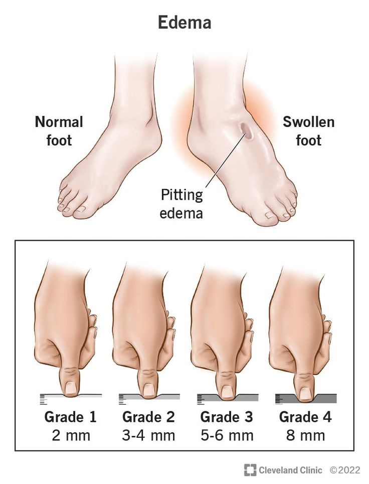 edema