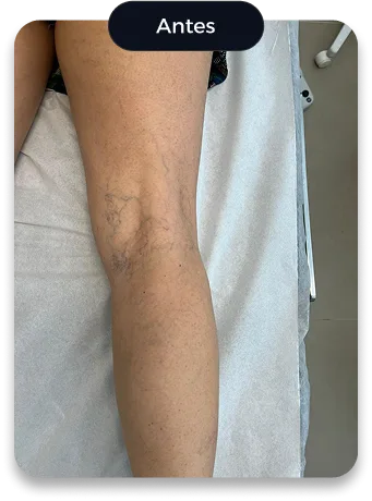 Antes do tratamento: perna com vasinhos e veias arroxeadas em volta do joelho
