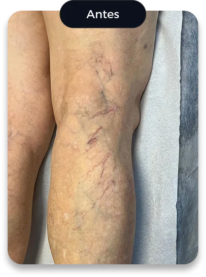 Perna com vasinhos e veias dilatadas, marcada como Antes do tratamento