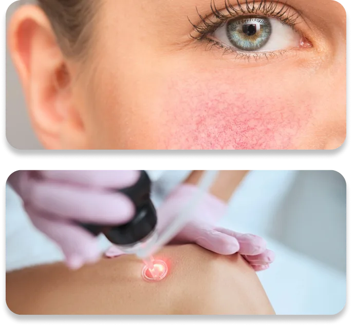 Vasinhos avermelhados no rosto de uma mulher e aplicação de laser na perna por profissional de luvas