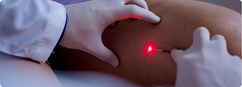 Endolaser (Laser endovenoso) em Brasília