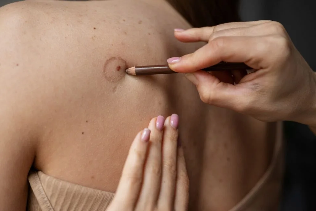 Mãos marcando com um lápis uma pinta na pele do ombro de uma mulher