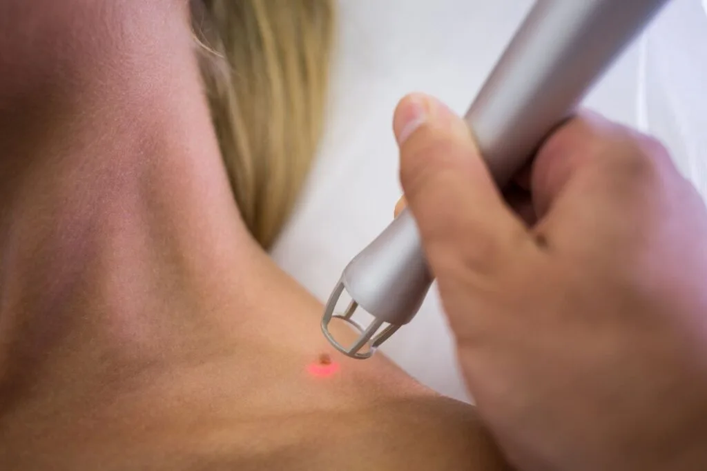 Aplicação de laser com ponteira sobre pequena lesão avermelhada na pele, próxima ao ombro