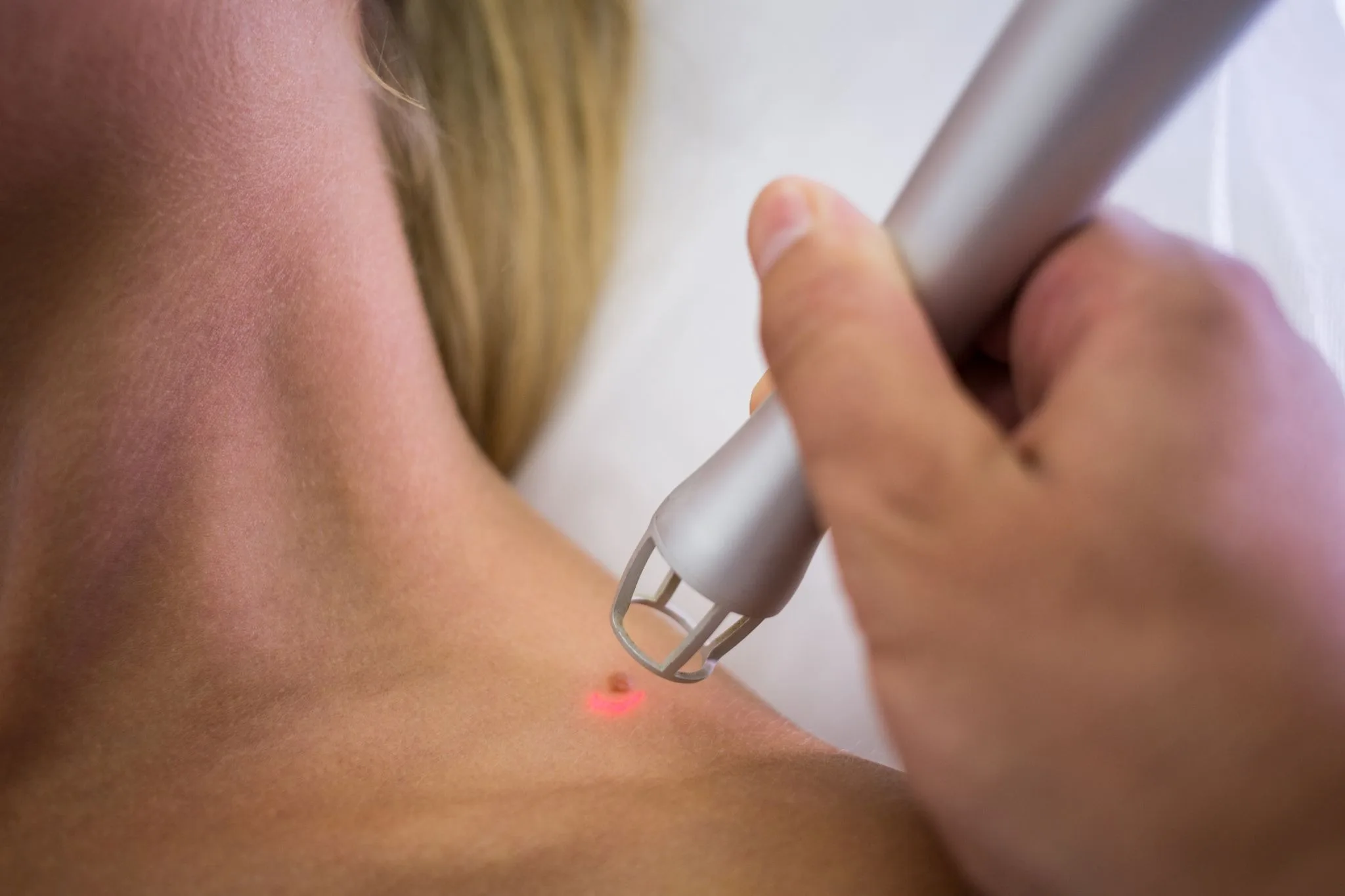 Aplicação de laser com ponteira sobre pequena lesão avermelhada na pele, próxima ao ombro