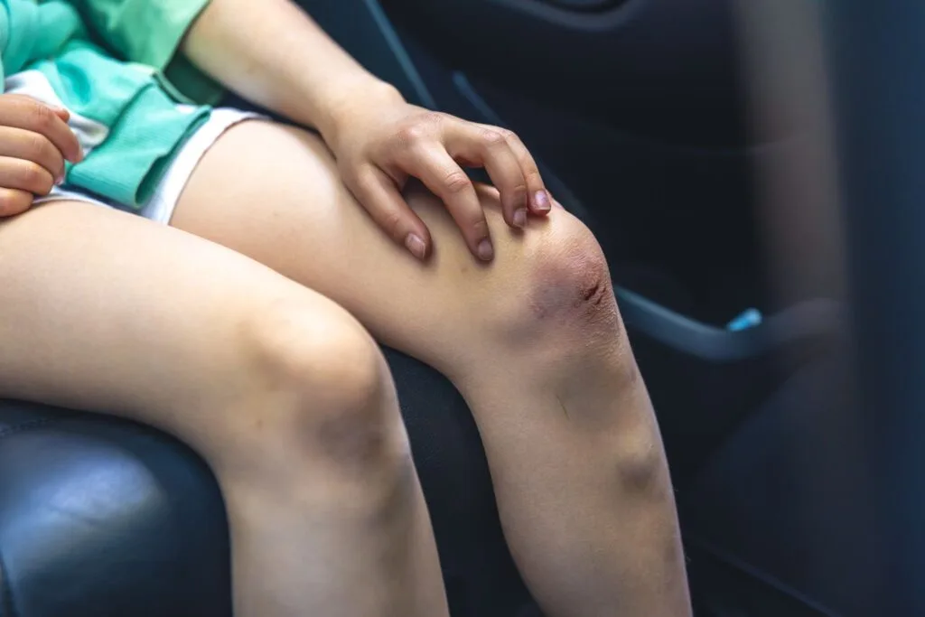 Criança sentada no banco do carro com o joelho ralado e arroxeado, tocando a área machucada